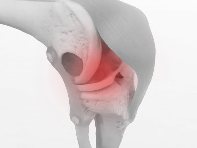 変形性膝関節症と軟骨がすり減ることは関係ない