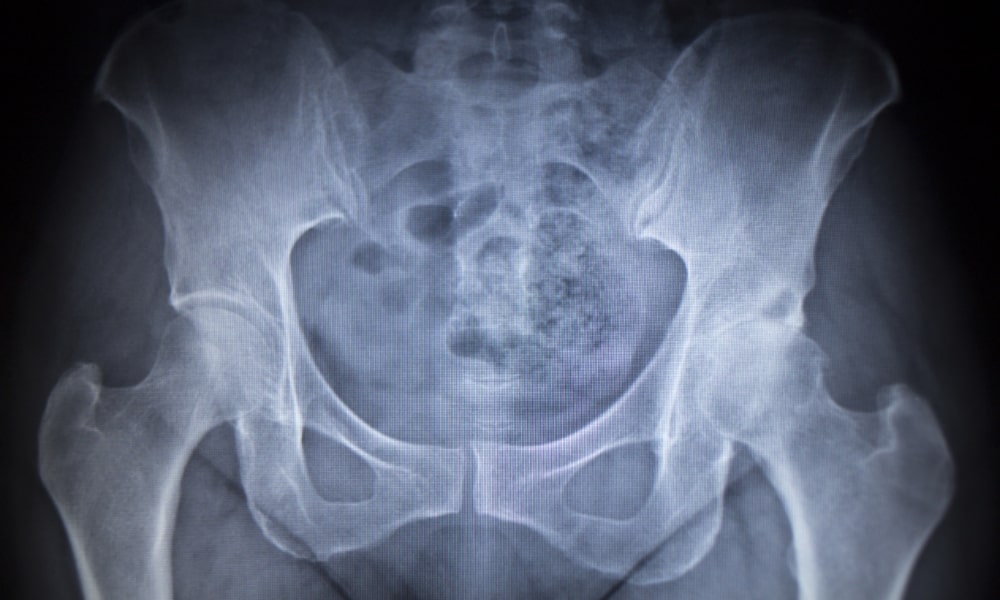 座るとお尻が痛い場合の変形性股関節症