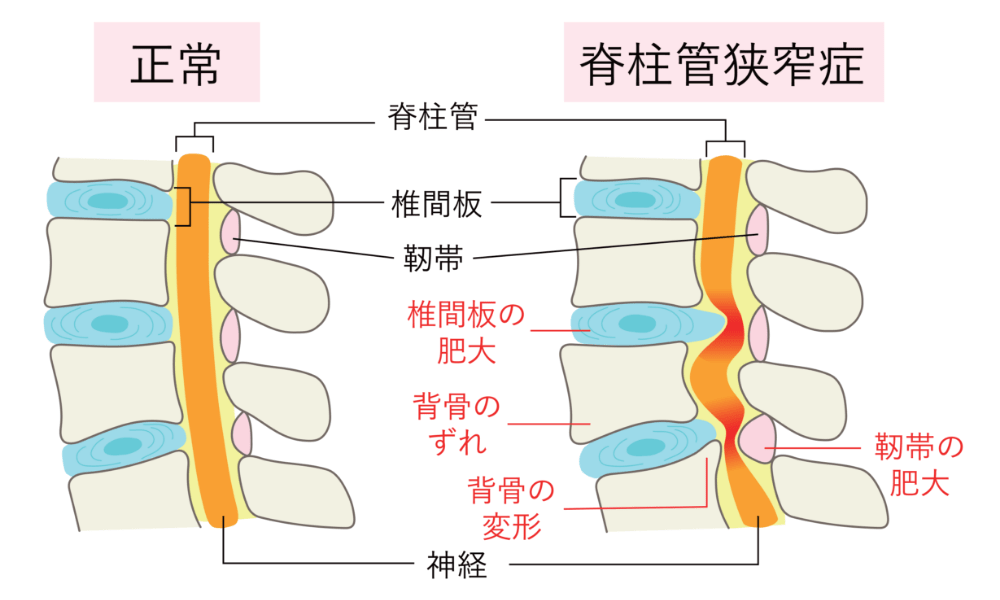 座るとお尻が痛い脊柱管狭窄症の原因
